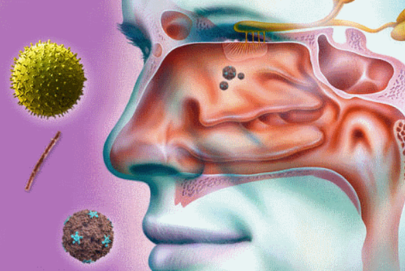 Синусит и аллергия: связь и способы профилактики