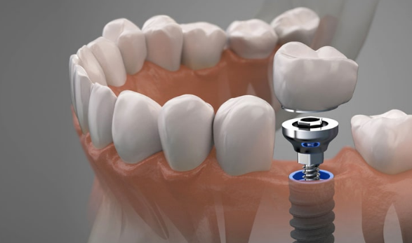 Имплантация зубов: Восстановление и Современные Технологии