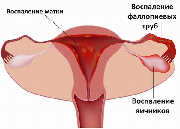 Показания к применению боровой матки при эндометриозе