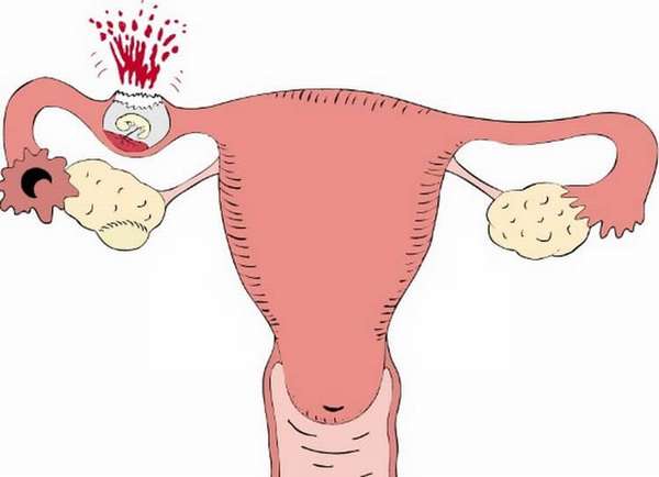 Какие симптомы внематочной беременности на раннем сроке