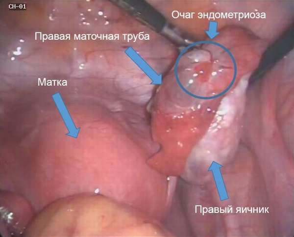 Фото эндометриоза на правом яичнике