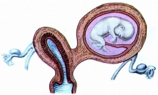 Появление у женщины внематочной беременности