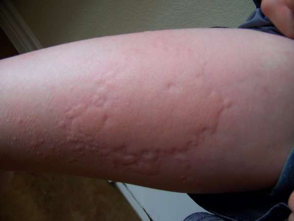 Аллергия в виде волдырей на коже – как и чем лечить?