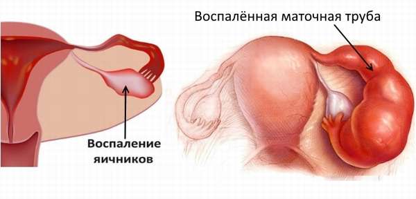Воспаление яичников и маточной трубы