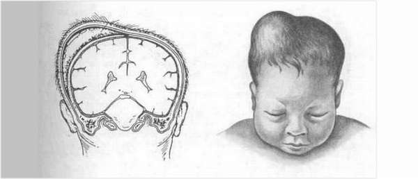 признаки пункции кефалогематомы у новорожденных