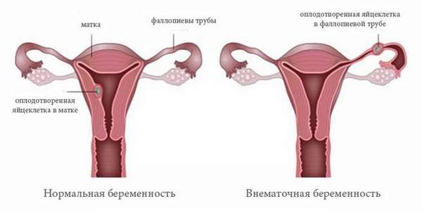 светло-коричневые выделения могут наблюдаться при внематочной беременности.