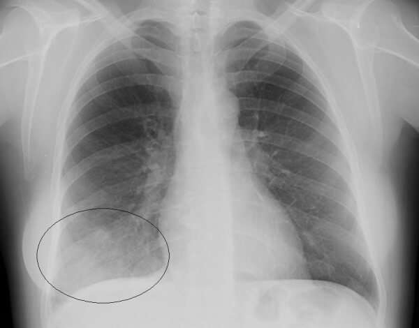 Рентген при пневмонии у ребенка фото thumbnail