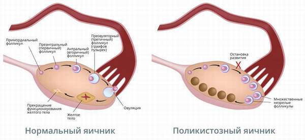 Классификация и особенности лечения железистой гиперплазия эндометрия