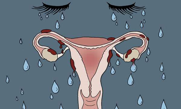 Как медикаментозно лечить эндометриоз матки таблетки и гормоны