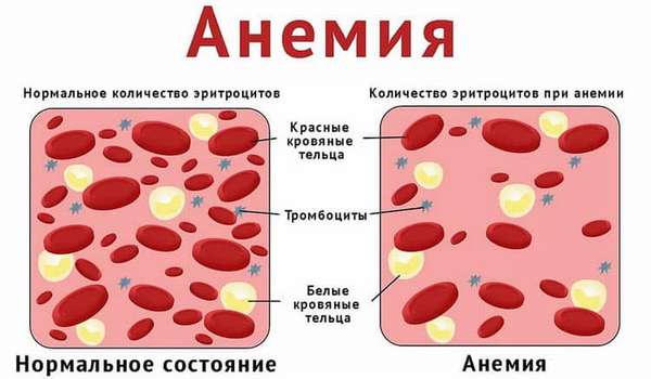 Как проявляется железодефицитная анемия у беременных