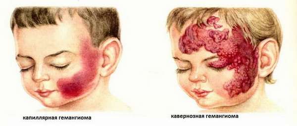 Виды гемангиомы у новорожденных на лице
