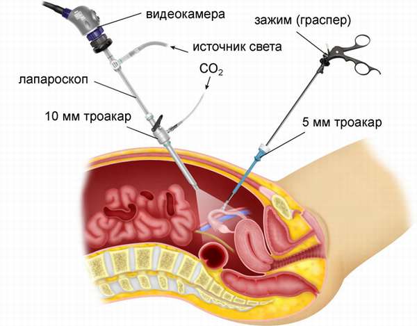 Как делается (проходит) лапароскопия маточных труб