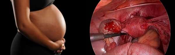 Апоплексия яичников и беременность