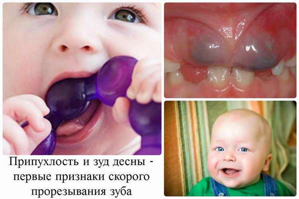 как понять что у ребенка режутся зубы