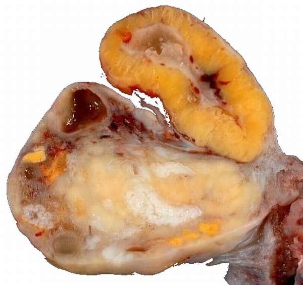 Киста жёлтого тела яичника в разрезе