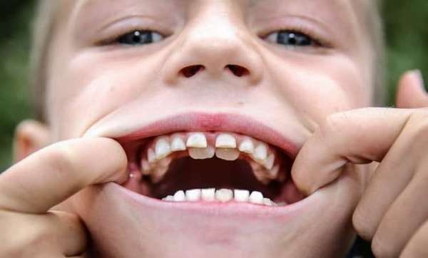 кривые зубы у детей фото
