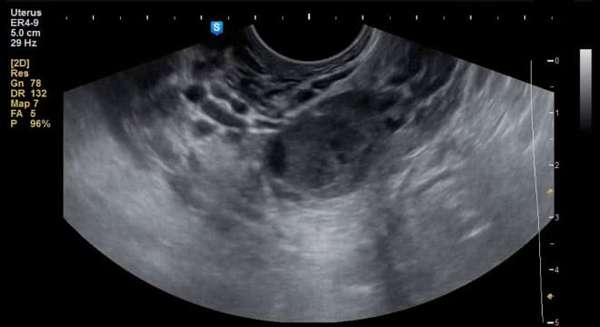 Снимок геморрагической кисты яичника на УЗИ