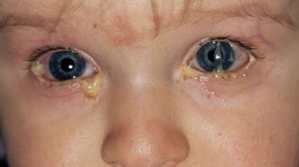 При бактериальном конъюнктивите у ребенка нередко могут просто слипаться глаза от гнойных выделений.