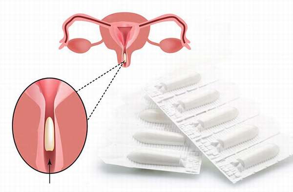 Самые эффективные свечи для лечения эндометриоза матки