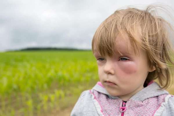 Все о том как проявляется аллергия у детей