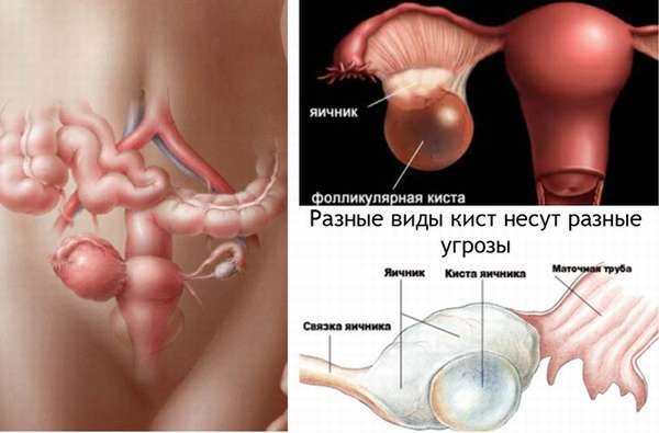 Терапия функциональной кисты яичника симптомы патологии