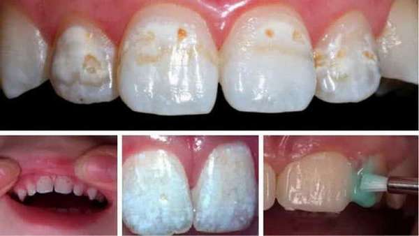 Отличие глубокого фторирования зубов у детей от фторирования гель-лаком