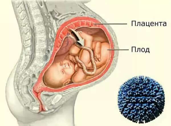 Внутриутробная пневмония у новорожденных выживаемость thumbnail