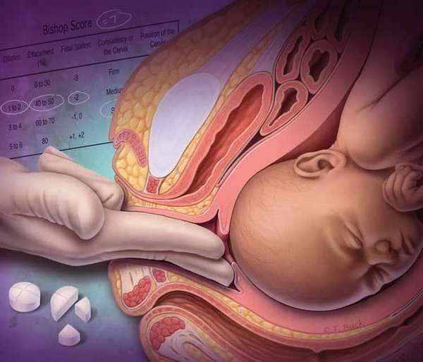 Как действуют таблетки для стимуляции родов