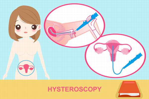 Как и для чего делают гистероскопию матки
