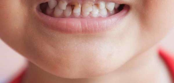 фторирование зубов детям противопоказания
