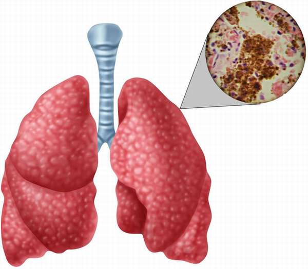 После перенесенного туберкулеза формируется пожизненный иммунитет thumbnail