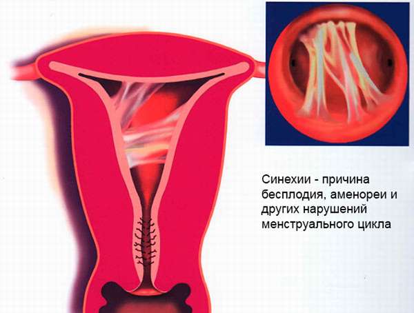 Лечение синехий в полости матки