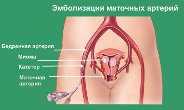 При каких размерах миомы матки делают операцию