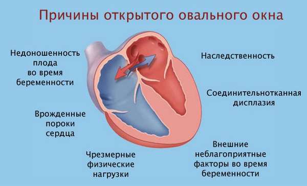 Причины ООО сердца у новорожденных до конца не установлены.