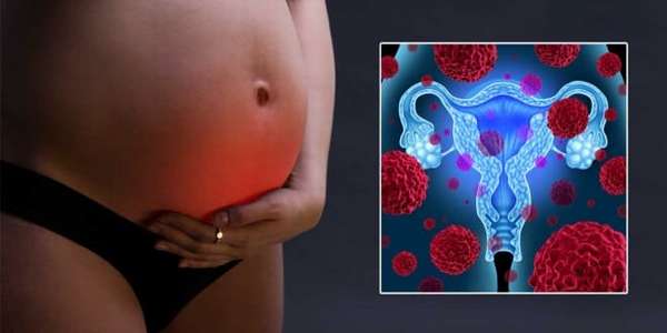Кистоз яичников при беременности