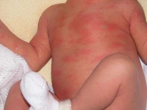 Если у новорожденного шелушится кожа на теле, это могут быть признаки физиологической эритемы.
