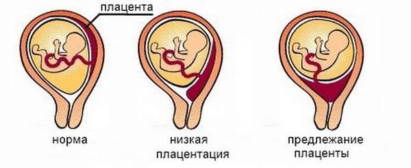 Как обнаруживается низкая плацентация и короткая шейка матки при беременности в 20 недель.