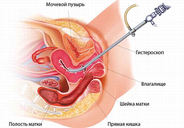 Медикаментозное лечение гиперплазия матки определение симптомов