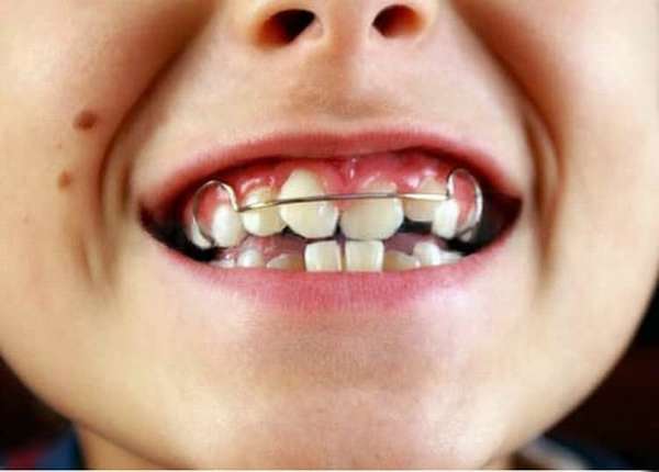 пластина на зубы детям: фото