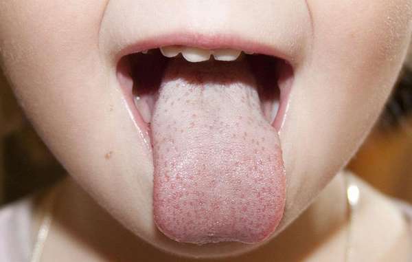 Такой налет на языке нередко появляется у детей с дисбактериозом.
