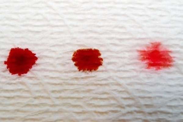 Выделения с кровью при заболевании придатков матки