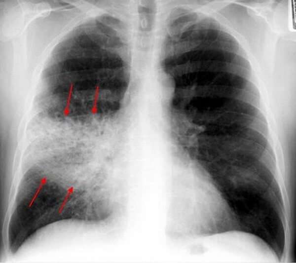 Описание рентгена легких при пневмонии у ребенка thumbnail