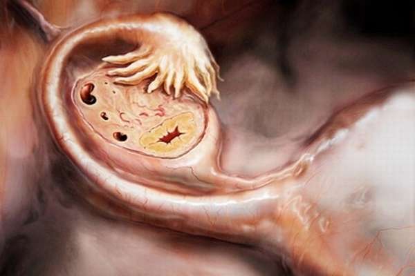Фото увеличенного женского яичника