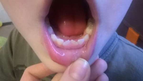 Почему кривые зубы у детей: молочные и коренные, фото