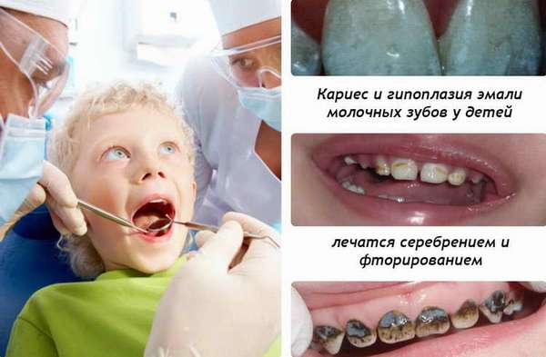 как происходит фторирование зубов у детей