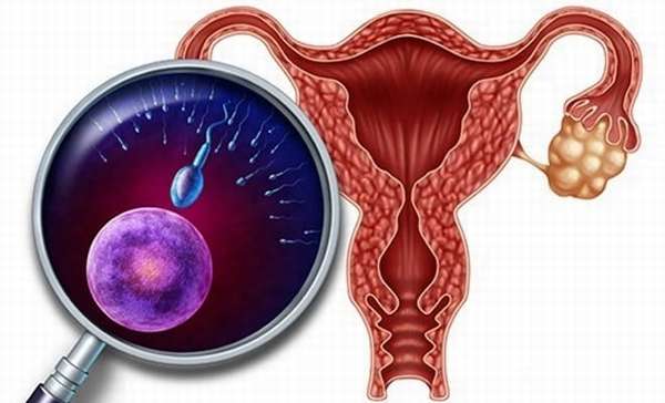 Гиперфункция яичников у женщин
