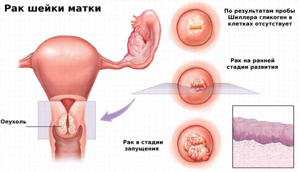 Первые признаки рака матки на ранней стадии