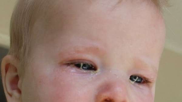 Одним из распространенных симптомов конъюнктивита у детей является закисание глаз.