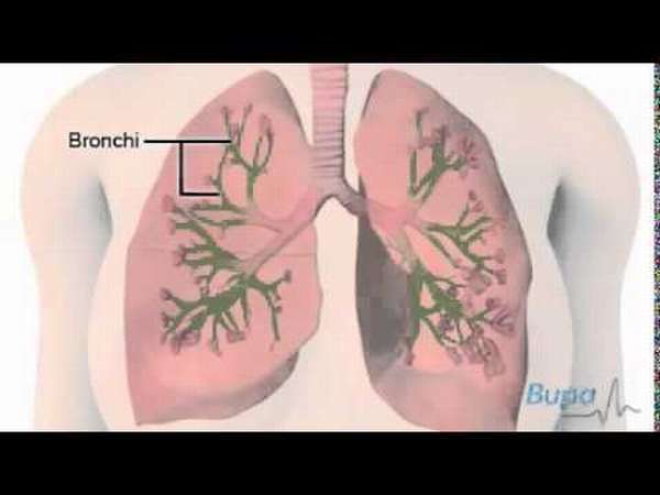 Синдром обструкции дыхательных путей лечение