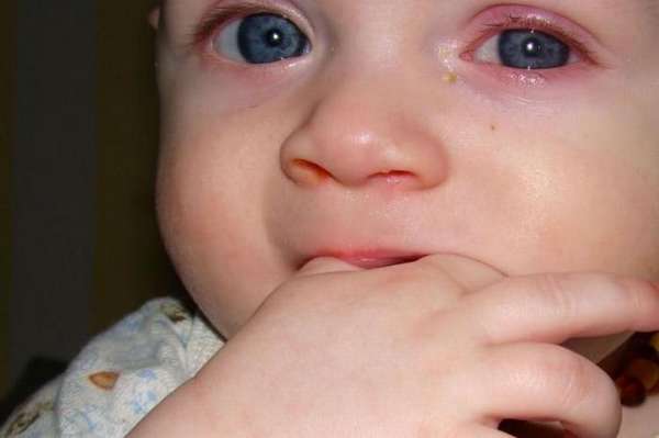 Глазные капли Левомицетин могут назначить даже для детей до года.